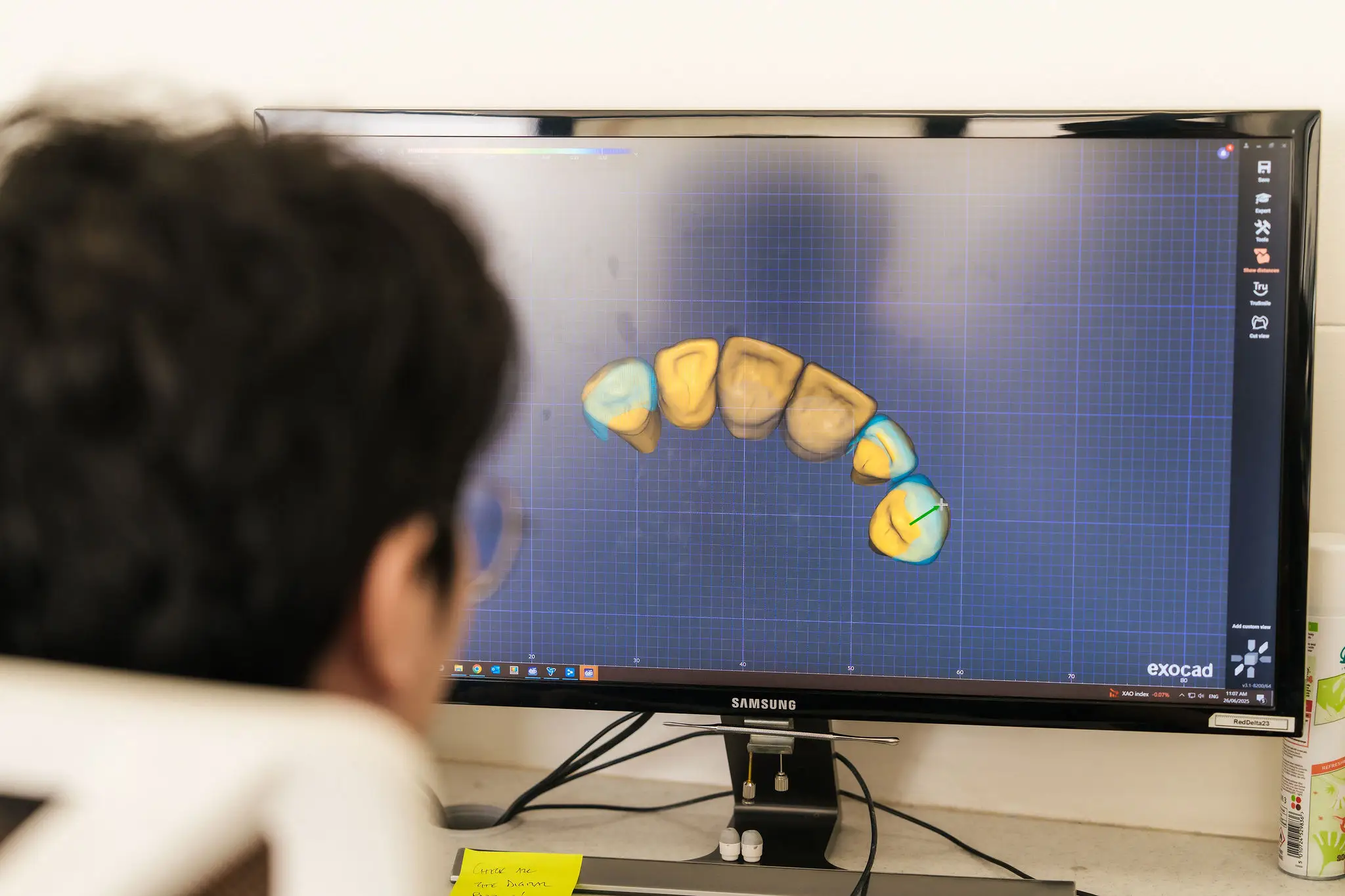 RWD Dental technician reviewing a digital 3D model of teeth on an exocad screen for digital smile design in a digital dental laboratory.