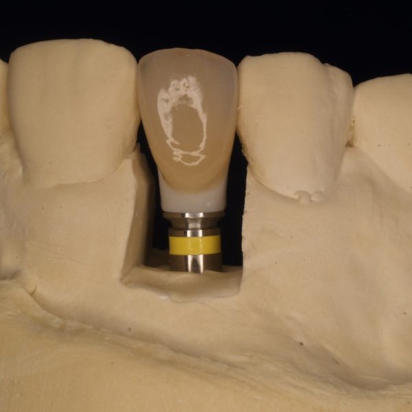 Ceramic crown fitted on a titanium dental implant, crafted by RWD Dental Image – a Sydney dental crowns bridges lab specialising in precision restorations.